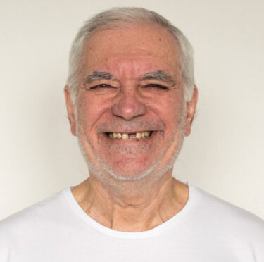 Various-Treatment-Options-For-Broken-And-Chipped-Teeth- Blog