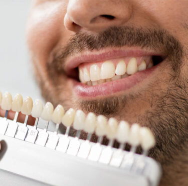 Veneers-The-Easy-and-Quick-Approach-Towards-Tooth-Restoration