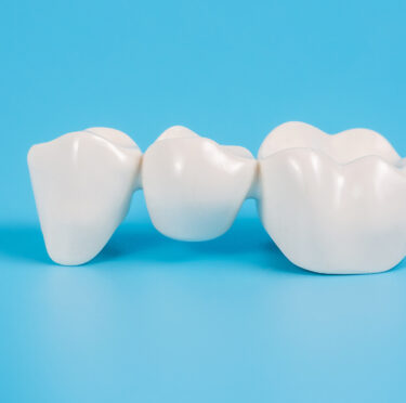 Dental-Bridges-FAQ- Blog