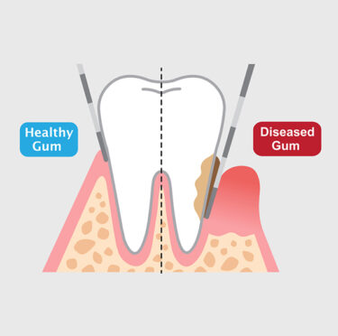 Gum disease Image